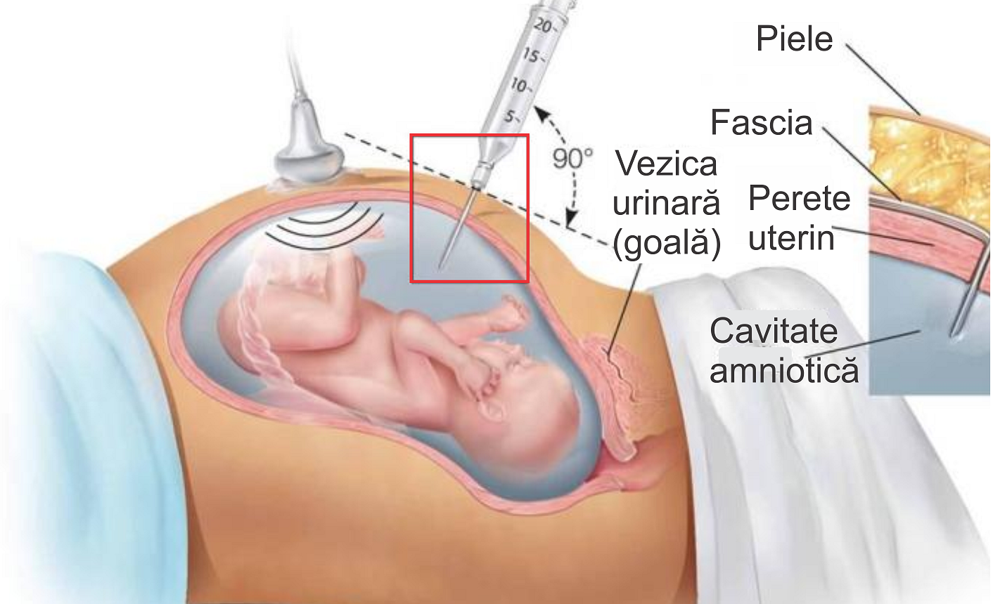 Amniocenteza