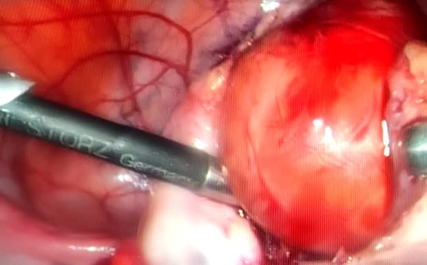 Chist dermoid de 4 cm extirpat laparoscopic